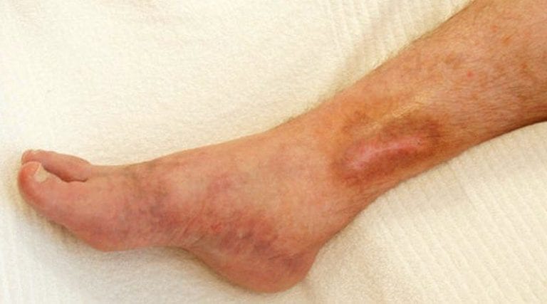 Venous Stasis Ulcer Pictures Canada Vein Clinics 4361