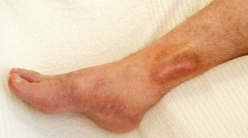 5 Tips To Prevent Varicose Veins and Varicose Ulcers - By Dr