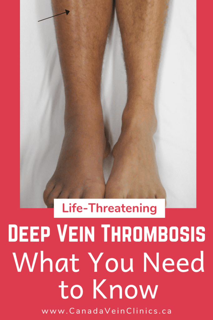 DEEP VEIN THROMBOSIS: SYMPTOMS, SIGNS, AND TREATMENT