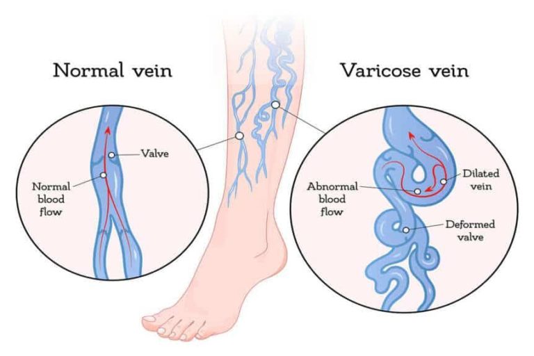 Does Botox help to remove Varicose Veins? | Canada Vein Clinics