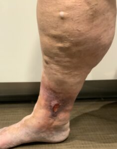 Venous leg ulcer near the ankle with surrounding skin discoloration and varicose veins
