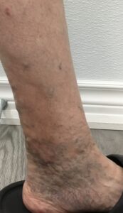 Brownish skin discoloration around the ankle caused by venous insufficiency