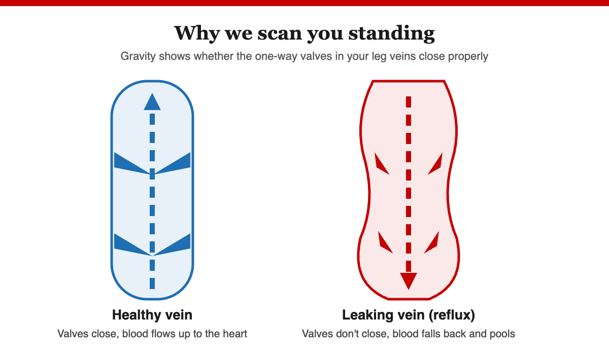 Diagram of a healthy leg vein with closed valves next to a leaking vein where blood flows backward (reflux)
