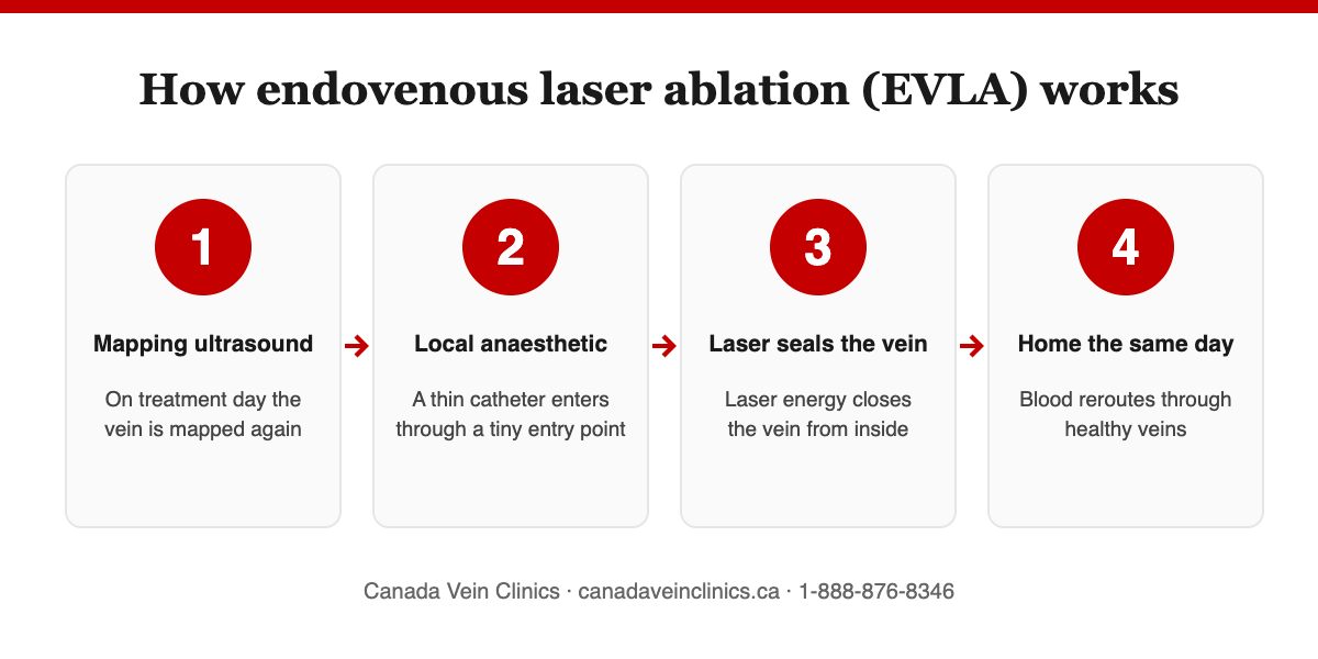 How EVLA works in four steps: mapping ultrasound, local anaesthetic, laser seals the vein, home the same day