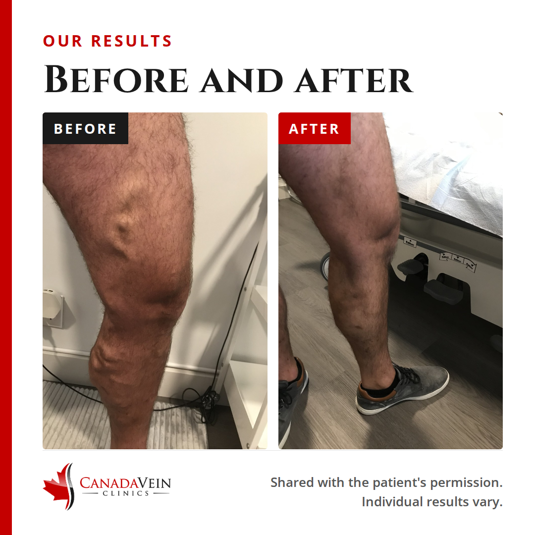 Our results: before and after treatment of varicose veins on the back of the calf