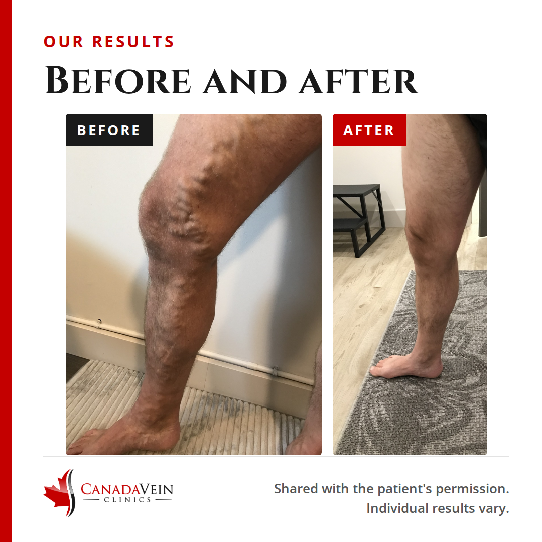 Our results: before and after treatment of severe varicose veins