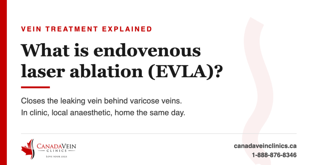 What is endovenous laser ablation (EVLA)? Canada Vein Clinics